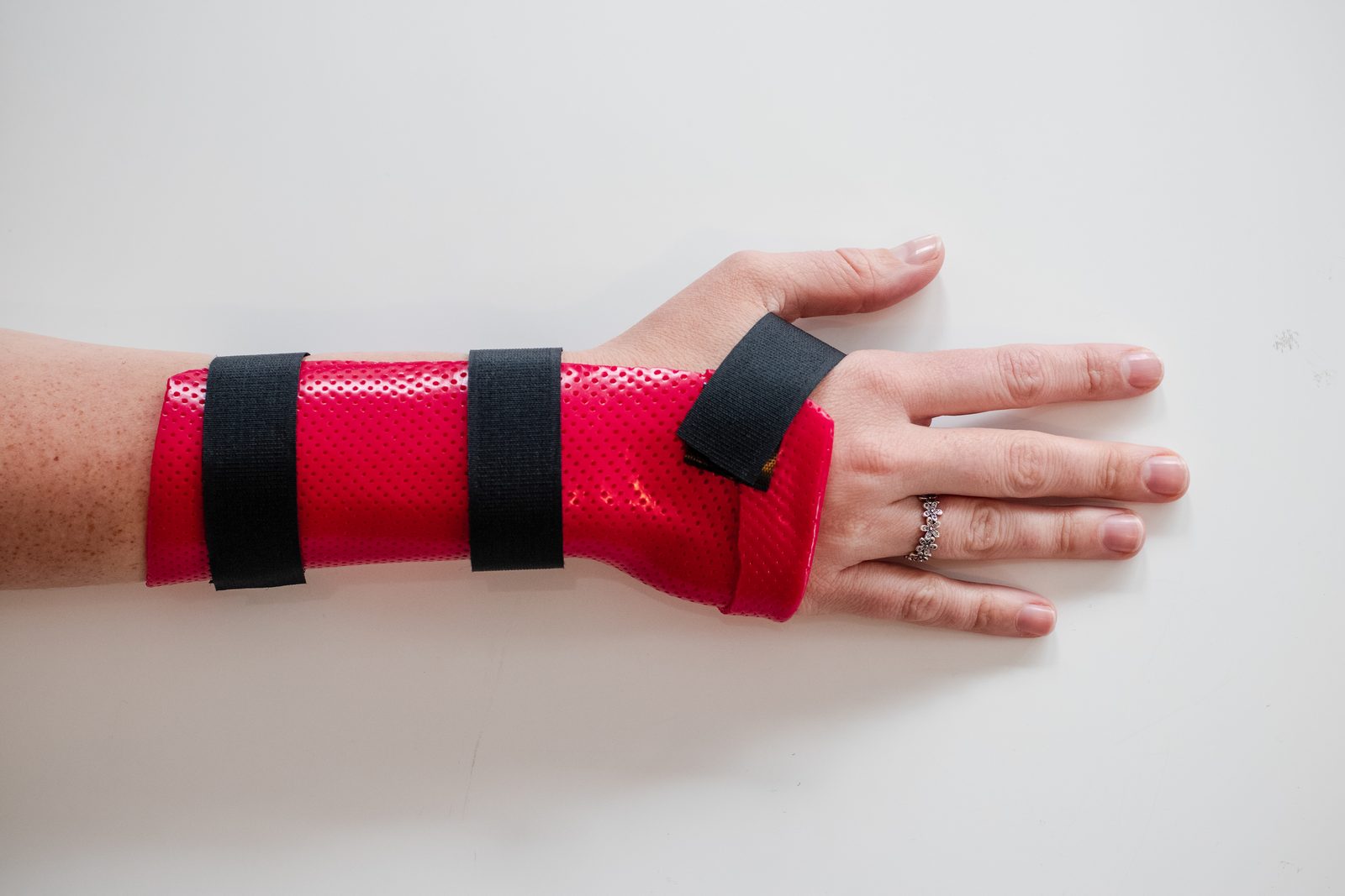A custom-fitted wrist splint made on-site at Restore Hand Therapy